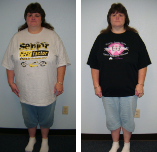 Before and after weight loss pictures of a woman
